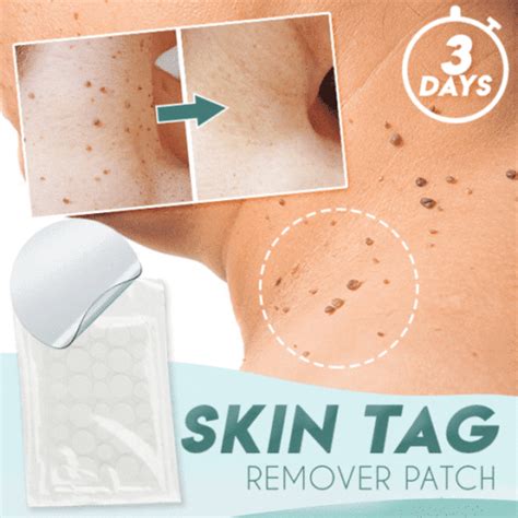 Skin Tag Remover Patch Buy Today Get 55 Discount Molooco