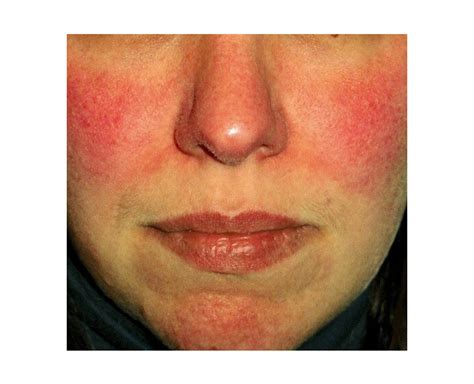 Common Skin Rashes In Adults Face Images And Photos Finder