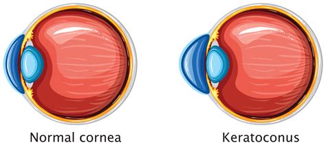 Cornea Beverly Hills Cornea Cross Linking Orange County Gaster Eye