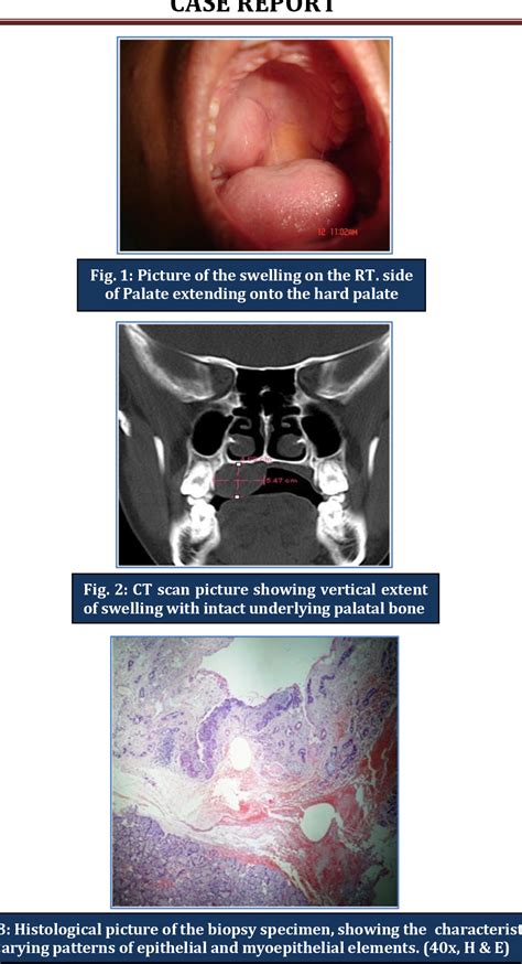 Figure 3 From Tumor Of Palatal Minor Salivary Gland A Case Report