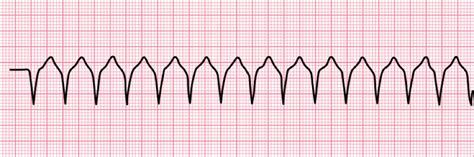 12 Lead Ecg Placement Aed Superstore Resource Center