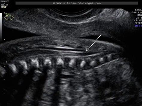 The right cells have to arrive in the proper location to ensure an organism is formed correctly. A Gallery of High-Resolution, Ultrasound, Color Doppler ...