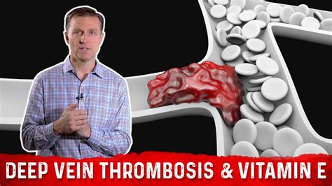 Deep Vein Thrombosis Blood Clots In Legs Vitamin E Dr Berg Youtube