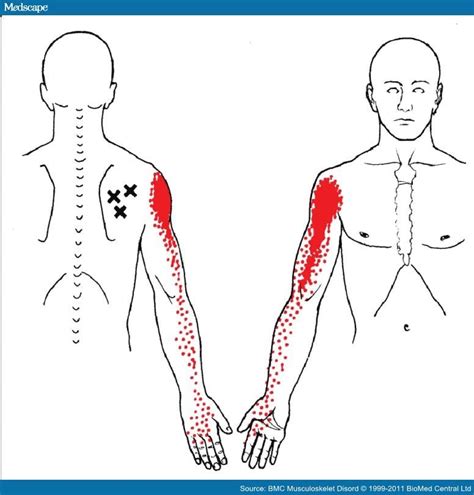 Myofascial Trigger Points In Patients With Shoulder Pain