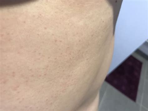 Ils permettent de dissimuler localement un petit bouton ou une rougeur. Petit bouton de partout sur le ventre! - Juillet 2017 ...