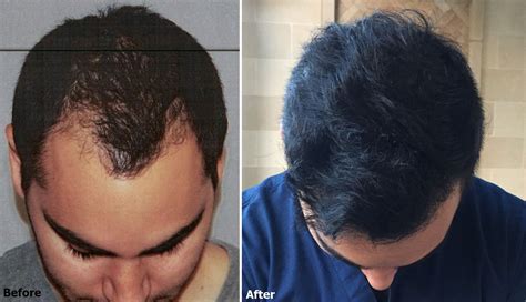When choosing a los angeles hair transplant doctor, there are a number of important factors to be considered. Result 6 | Hair transplant results, Hair restoration, Fue ...