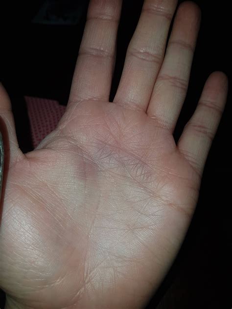 Purple Spot On Palm Of Hand Similar But Smaller Spot On Other Hand