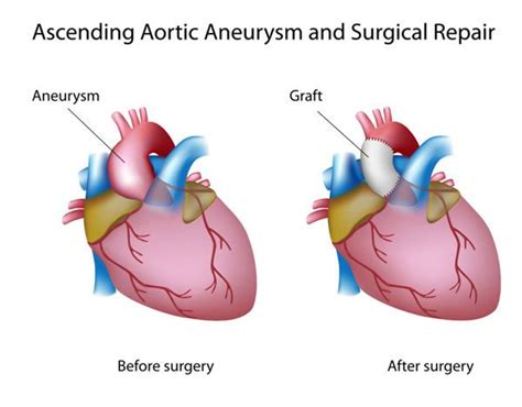 Top 5 Facts About Your Aorta And Bicuspid Aortic Valves Aortic Aneurysm