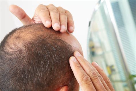 Hair Loss Treatment For Men Richmond