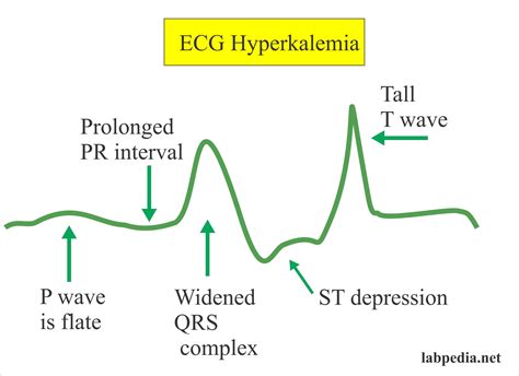 Electrolytes Part 4 Sodium And Potassium Na And K Ecg Changes