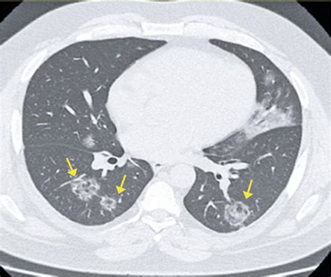 Covid 19 Findings Identified In Chest Computed Tomography A Pictorial