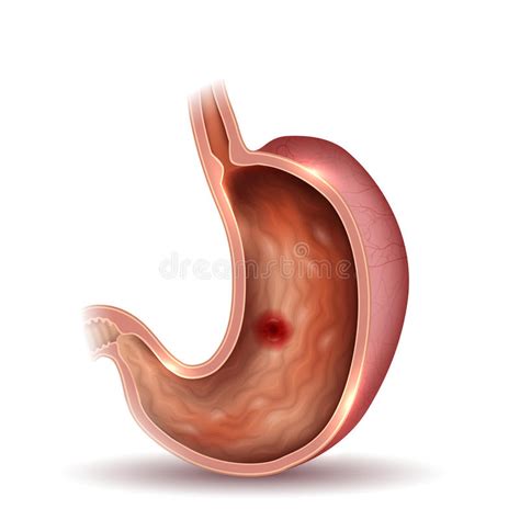 Ulcera Allo Stomaco Disegno Variopinto Di Anatomia Degli Organi Del