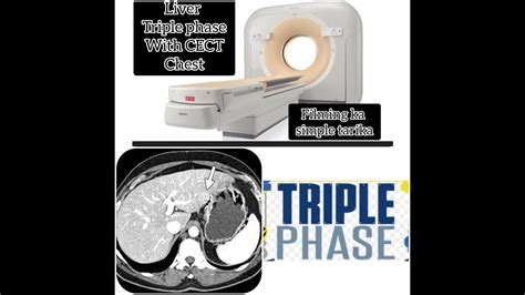 Ct Liver Triple Phase Cect Chest With Filming On Philipsct