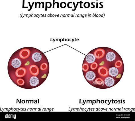 Linfocitos Por Encima Del Rango Normal En La Sangre Linfocitosis