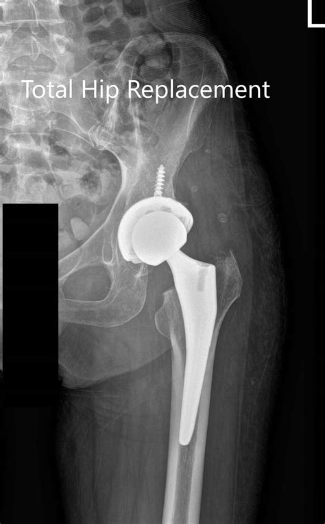 Case Study Bilateral Total Hip Arthritis In 66 Yr Old Male