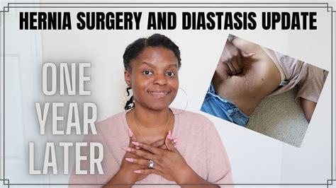 Hernia Repair Surgery And How Does Diastasis Recti Look One Year Later