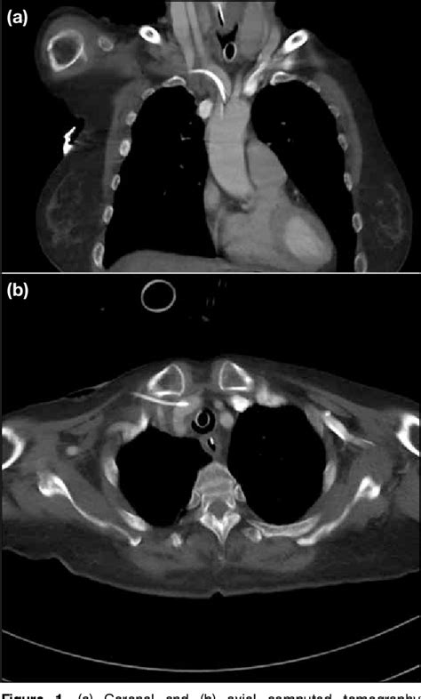 Figure 1 From Percutaneous Repair Of Inadvertent Brachiocephalic