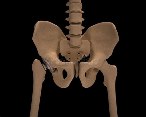 Human Skeleton With A Metal Hip Prosthesis Concept Arthroplasty Stock