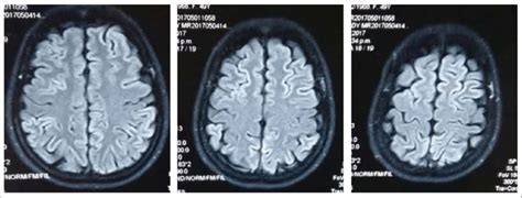 Diffusion Weighted Imaging Dwi Mri High Intense Signal Changes In