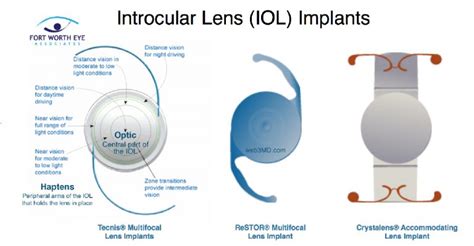 Intraocular Lens Implants Fort Worth Eye Associates