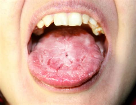 Black Spots On Side Of Tongue Kukkisuami