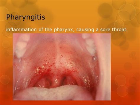 Disease Of The Pharynx