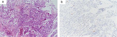 The Pathological Manifestations Of The Transbronchial Lung Biopsy A