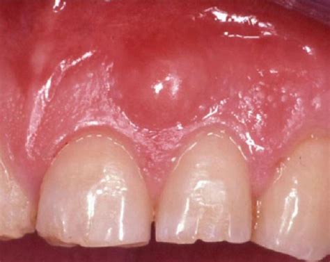 Absceso Dental Qué Es Causas Y Tratamiento Bqdc