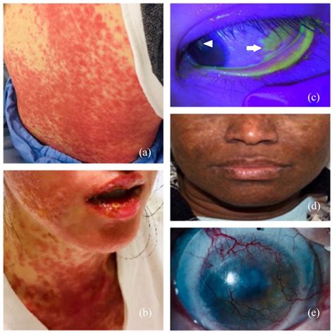 Steven Johnson Syndrome Lamictal