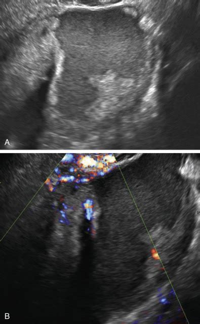 Ultrasound Evaluation Of The Ovaries Radiology Key