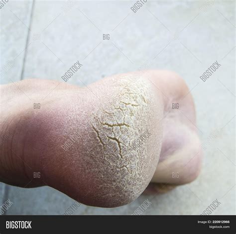Skin Diseases Foot Image And Photo Free Trial Bigstock