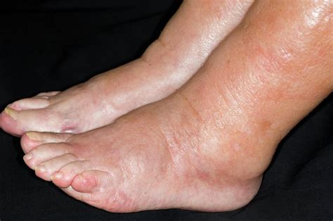 Ankle Oedema In Heart Failure Photograph By Dr P Marazzi Science Photo