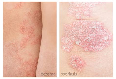 Diferencia De Cerca Entre Psoriasis Y Eczema Dermatitis Atópica