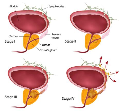 Trouble starting, not being able to urinate when the feeling is there, or poor urine flow) Disease Graphics, Videos & Images on Prostate Cancer