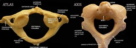The atlas is the thinnest and most delicate of the cervical vertebrae, consisting of a thin the posterior of the anterior arch meets the odontoid process of the c2 vertebra (axis) to form the median atlantoaxial joint. 50+ Parts Of Axis Vertebra - ガタコメッタ
