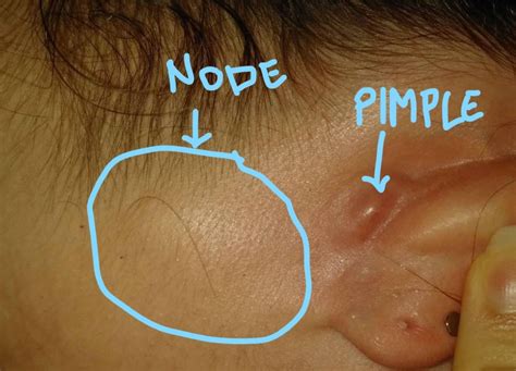 I Had A Painful Pimple At The Back Of My Ear So I Tried To Squeeze It