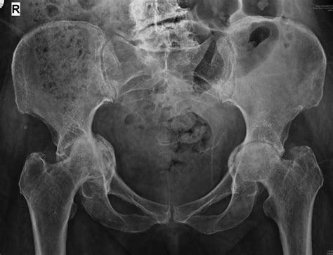 Bilateral Protrusio Acetabuli Of The Hip Bmj Case Reports