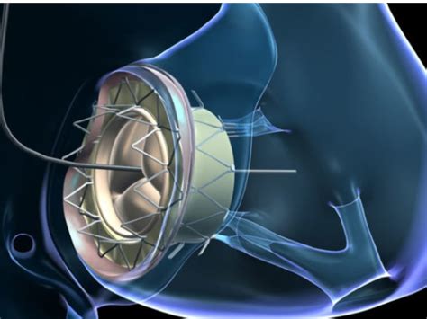 Study Shows Safety Of Transcatheter Tricuspid Valve Replacement With