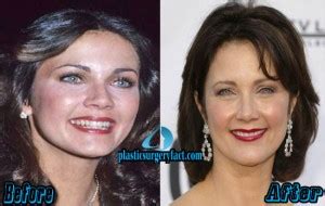 Lynda Carter Plastic Surgery Before And After Photos Plastic Surgery