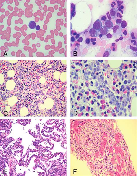 Histocytomorphology Of Ivlbcl A Rare Large Atypical Lymphoid Cells