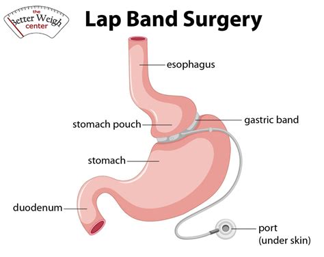 Lap Band Surgery Corpus Christi Lap Band Surgery Lap Band Gastric Band