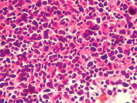 Figure 3 From T Cellhistiocyterich Diffuse Large B Cell Lymphoma