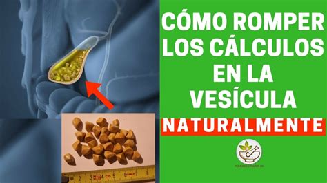 Como Eliminar Las Piedras De La Ves Cula R Pido Este Remedio Te Ayuda