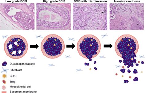 Progression Of Ductal Carcinoma In Situ To Invasive Carcinoma From A
