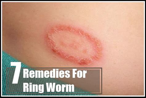 Pin By Yolanda White On Home Remedies Ringworm Ring Worm Treatment