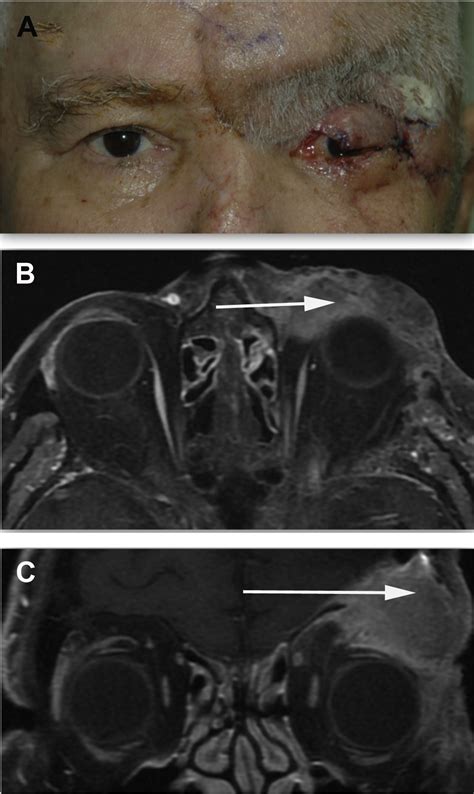 Locally Advanced Recurrence Of Periocular Squamous Cell Carcinoma And