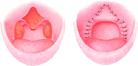 Uvulopalatal Flap Is A Modification Of Uvulopharyngoplasty Instead Of