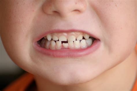 This cleaning process is known as scaling. Taysoms in the News: Loose Tooth