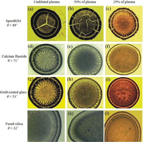 Drops Of Human Plasma Dried On Various Substrates At Different