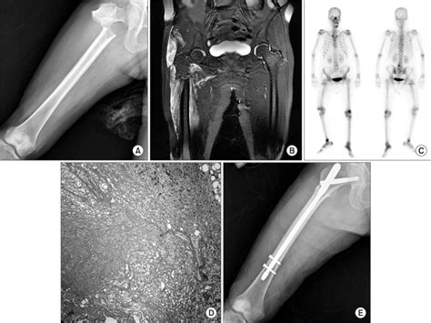 A An Atypical Subtrochanteric Femoral Fracture Was Shown On Simple